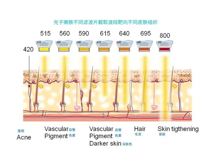 五大光子嫩膚技術(shù)（IPL、DPL、OPT、APT、BBL）及濾光片區(qū)別